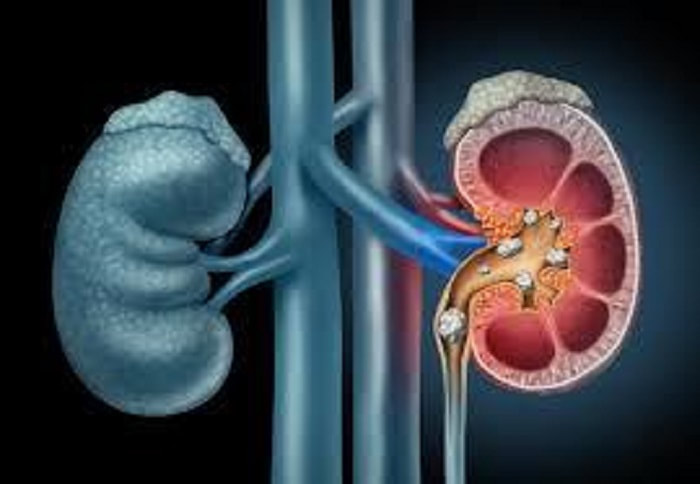 Homeopathy Treatment for Kidney Stones